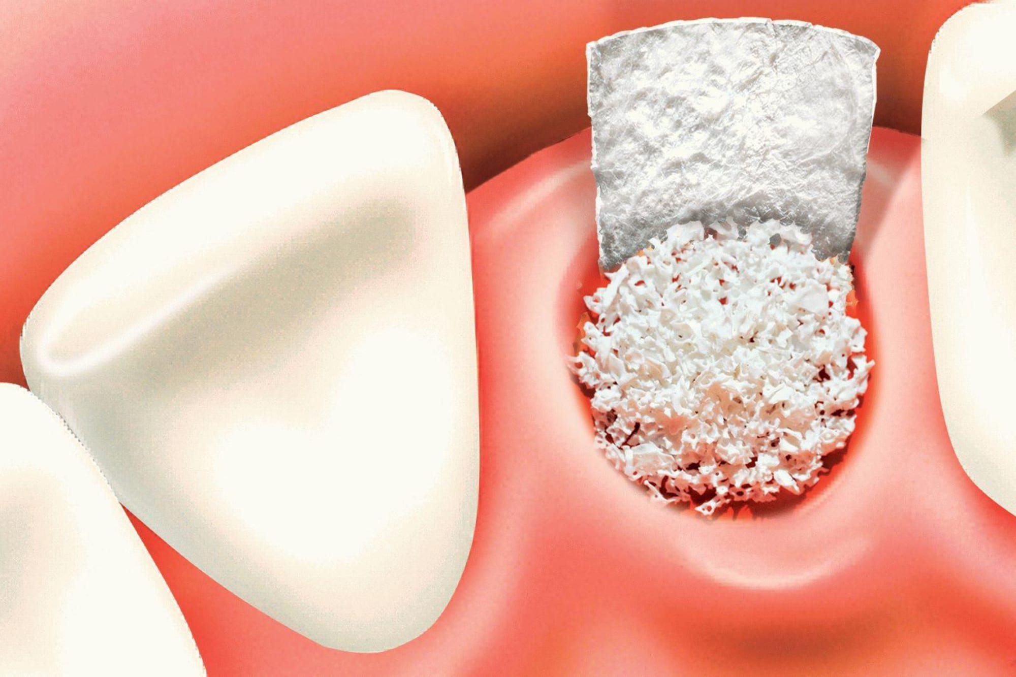 Восстановление костной ткани зубов. Костная пластика (остеопластика). Bone graft костный трансплантат. Костный материал в стоматологии. Костная пластика в стоматологии.